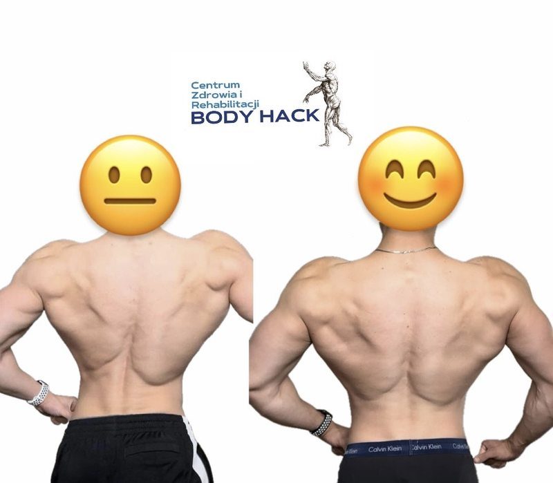 Efekt terapii — symetria mięśni pleców po rehabilitacji sportowej w BODY HACK Warszawa