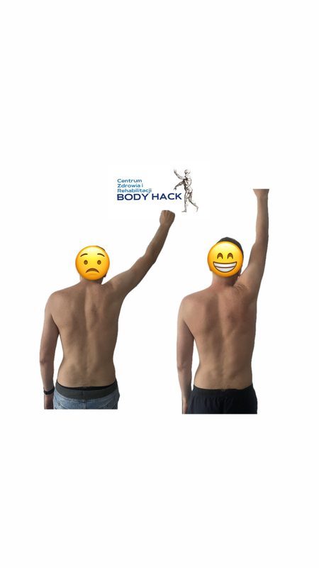 Efekt terapii — przywrócona ruchomość barku po terapii funkcjonalnej BODY HACK Warszawa